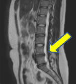 T2強調画像（腰椎ヘルニア症例）