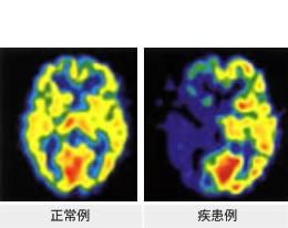 脳血流シンチグラフィ 正常例・疾患例