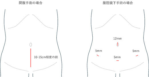 腹腔鏡下手術